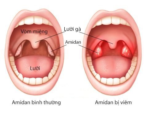 viem hong benh tuong nhe nhung cho coi thuong