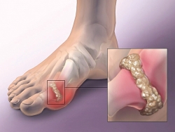 Bệnh gout và chế độ ăn cho người bị bệnh gout