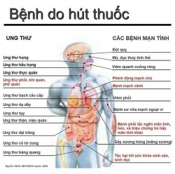 Hút thuốc lá có nguy cơ mắc ung thư phổi cao gấp 10 lần bình thường